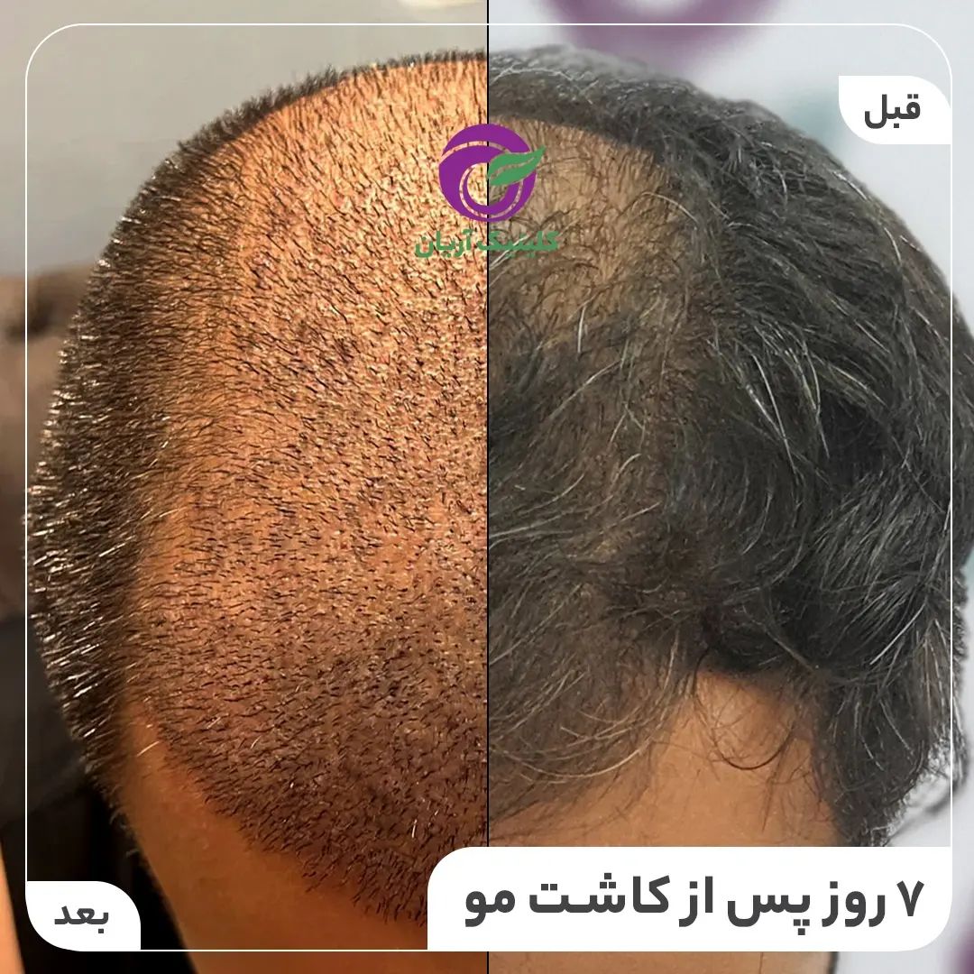 گالری کاشت مو 